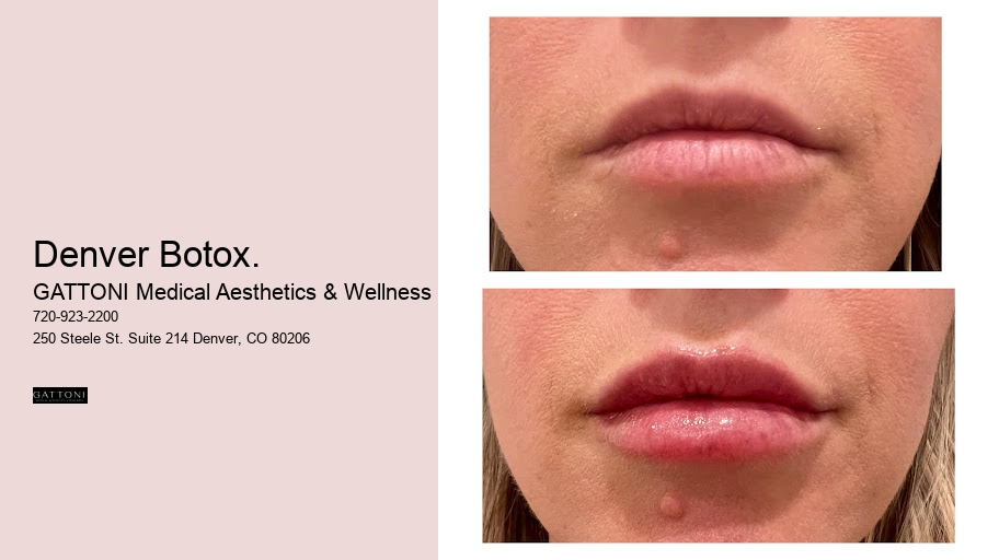 Denver Botox.
