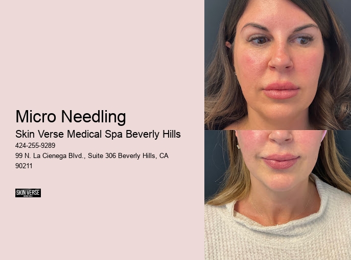 Micro Needling